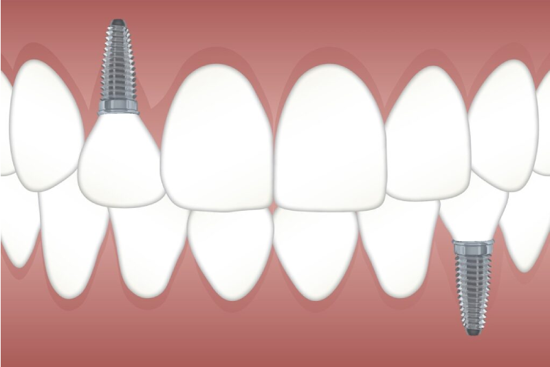 சென்னையில் பல் இம்பிளான்ட் மேற்கொள்ள ஆகும் செலவுகள்